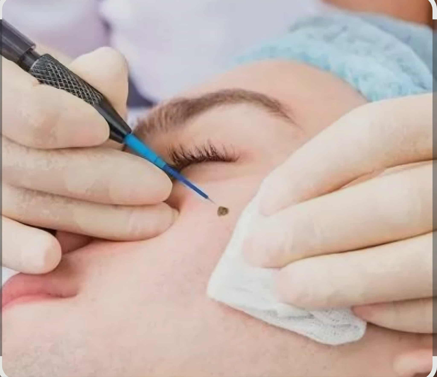 Wart-B-Gone (Warts/Skin Tag Removal)