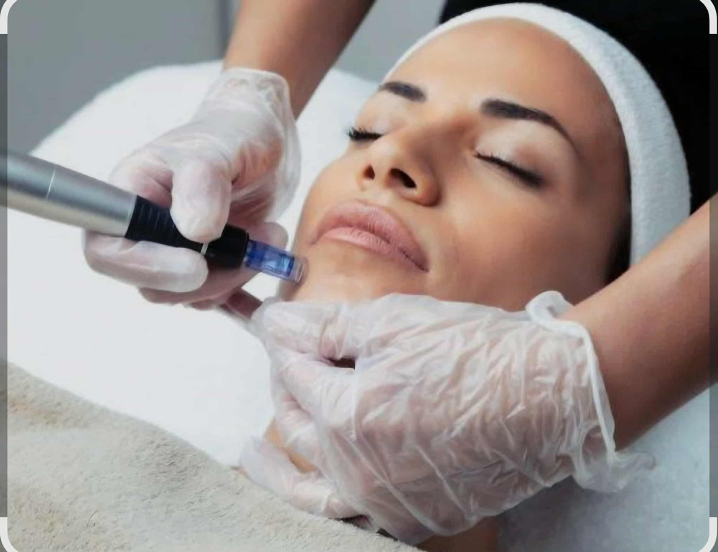 Clear Skin Microneedling - Acne & Scar