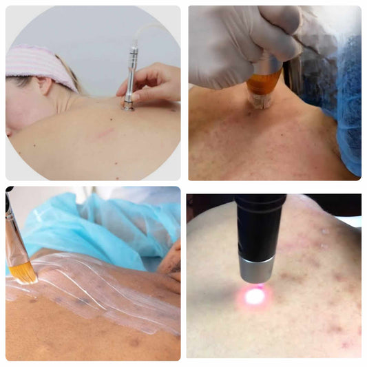 Back-cial or Back Acne Facial