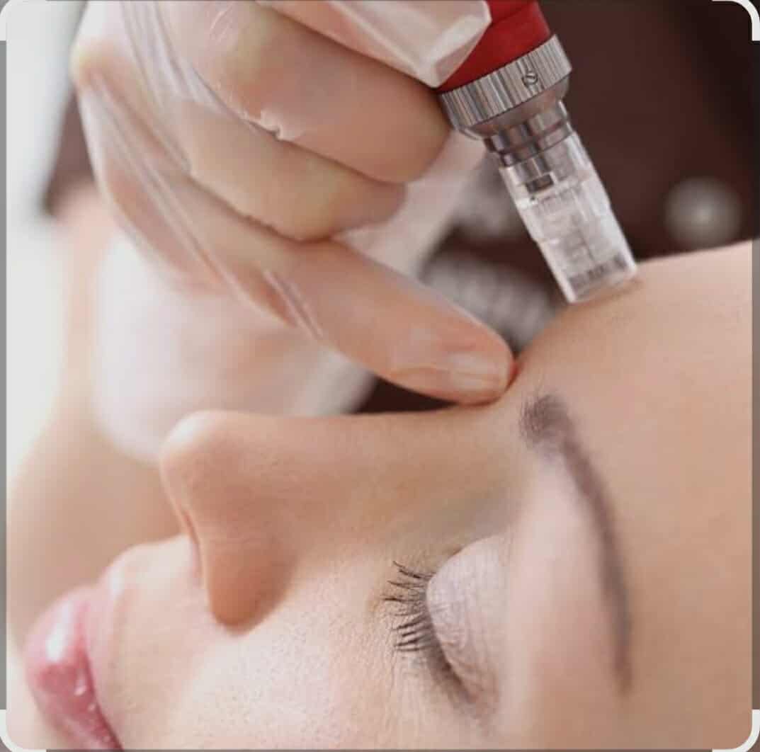 Radiance Boost Microneedling - Skin  Brightening & Pigmentation
