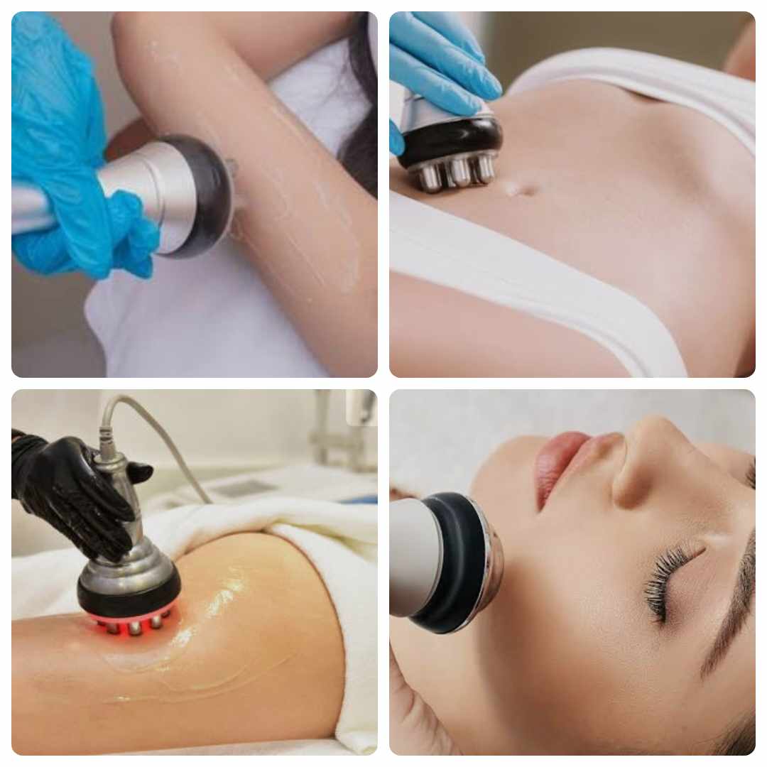 RF (Radio Frequency) Treatment
